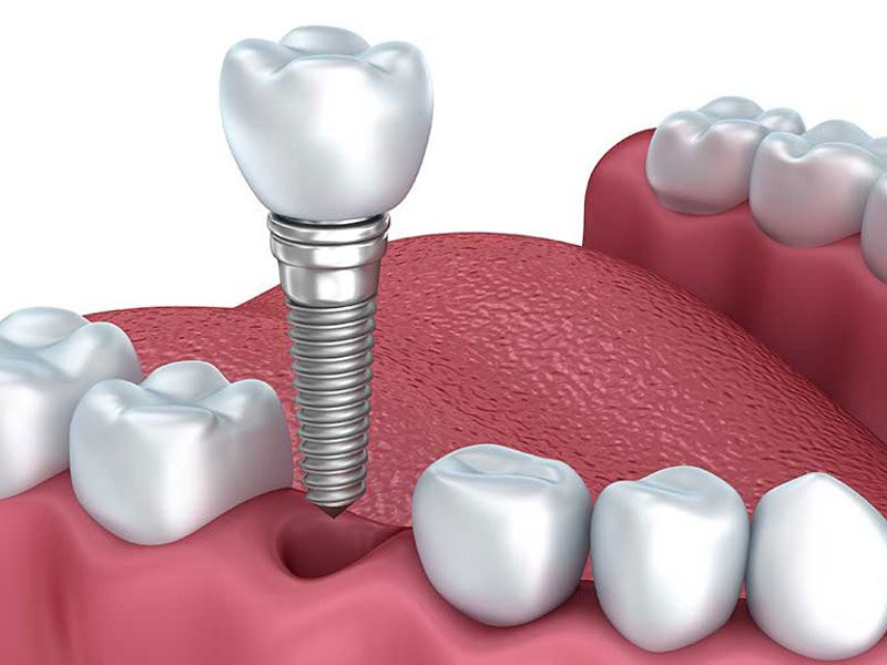 Quy trình trồng răng implant mất bao lâu? Toàn bộ thời gian từ A–Z bạn cần biết