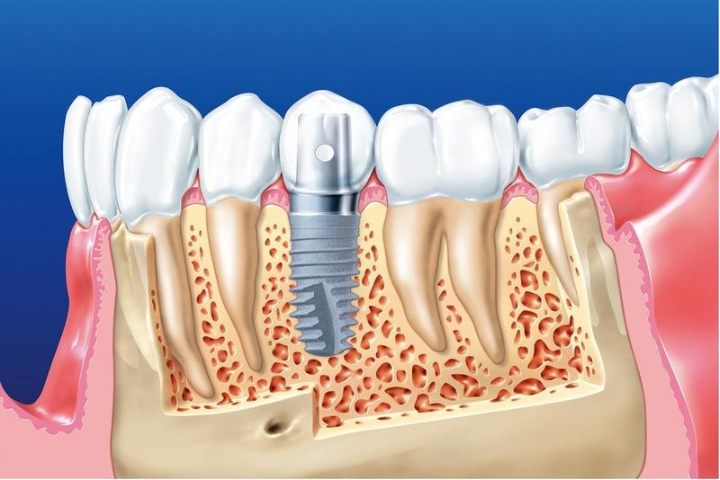 Trồng răng implant có đau không? Sự thật bạn cần biết trước khi quyết định