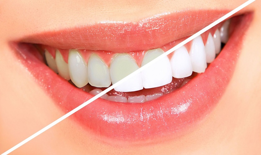 Cosmetic Dentistry: Simple Ways to Whiten Teeth at Home