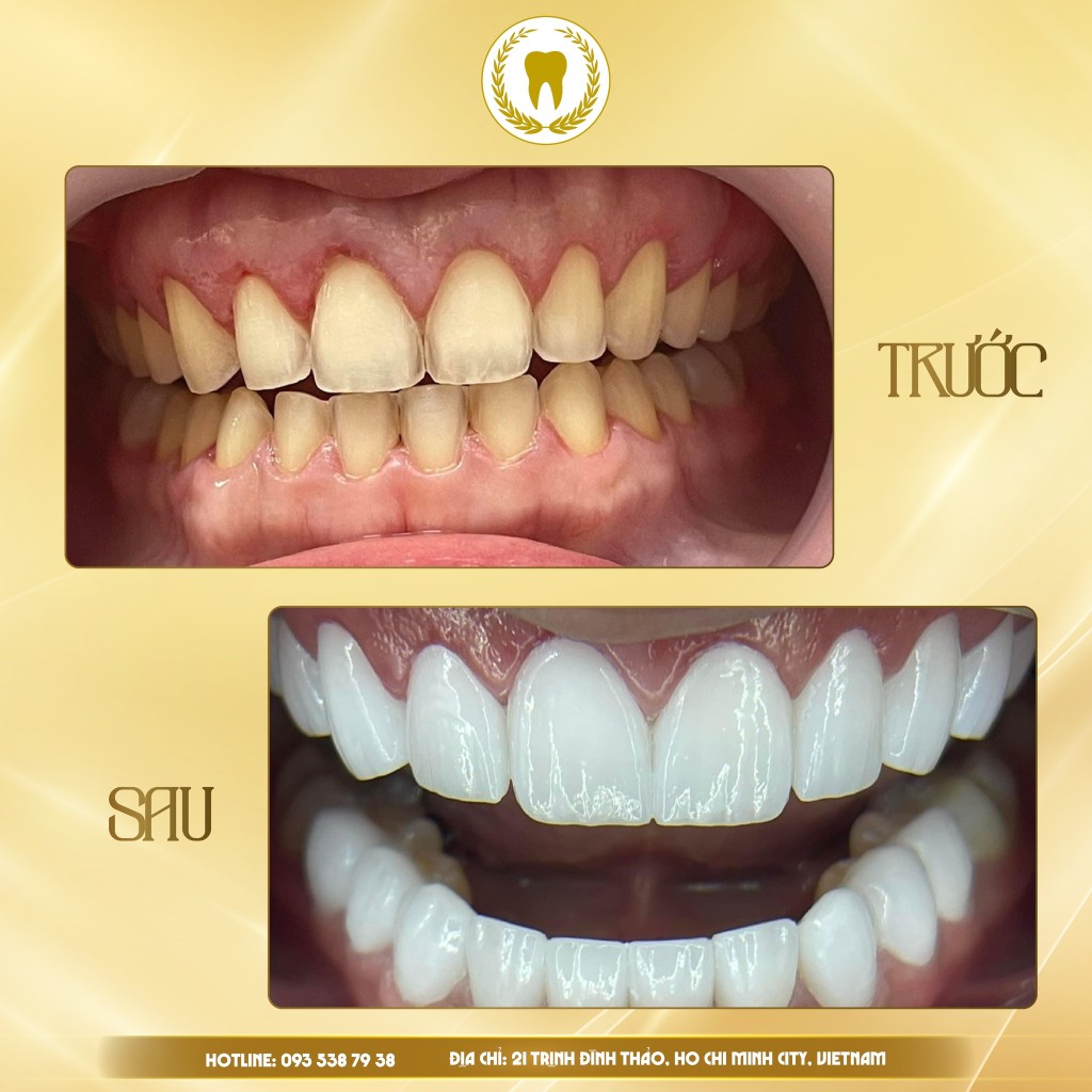 RĂNG SỨ ZIRCONIA