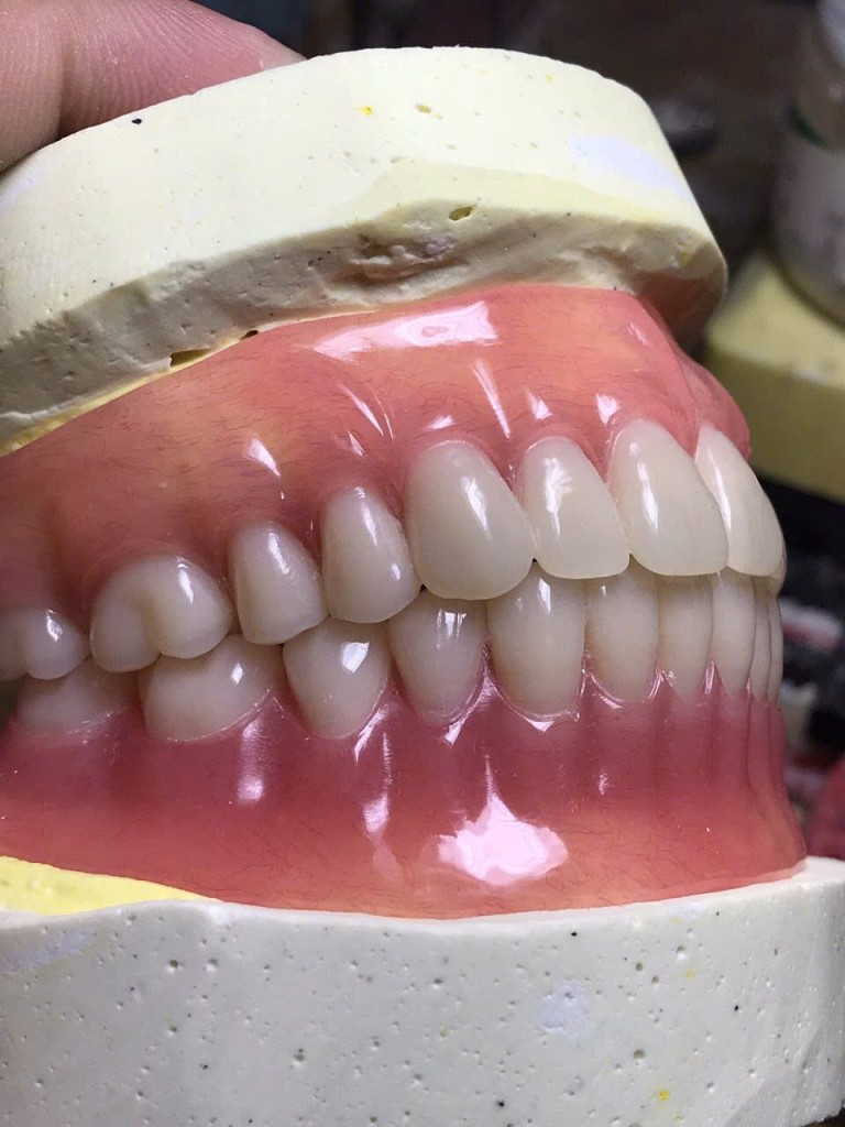 Removable dentures