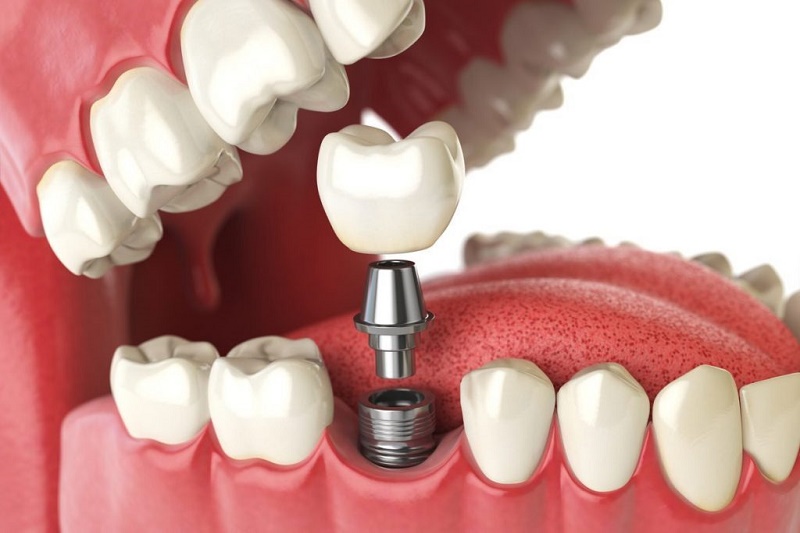 đặt trụ implant