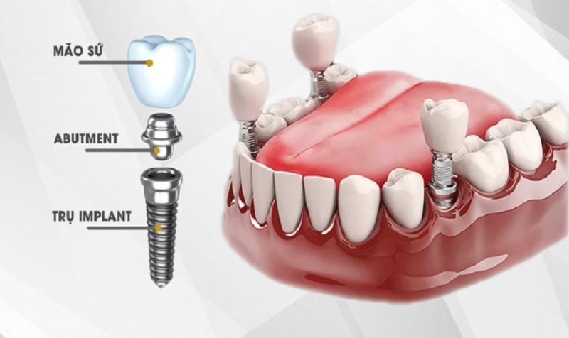 trồng răng implant là gì